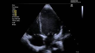 A selection of echocardiography views using the P84 transducer on the Siemens Acuson P500 [upl. by Gnas]