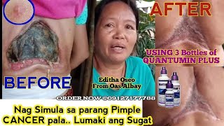 Sugat na hindi Gumagaling at cancer na daw NALUNASAN Miracle AmazingTestimony [upl. by Yenaled]