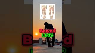 ✅bowed legs exercises DAY 10 🦍armylover trending bowedlegs motivation desiworkout [upl. by Ilrahs]