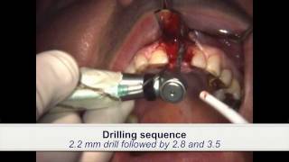 Dental Implant Placement in patient treated with iv bisphosphonates [upl. by Doubler]