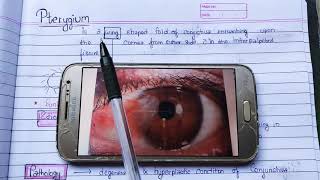 Pterygium theory exam notes AK Khurana [upl. by Lempres892]