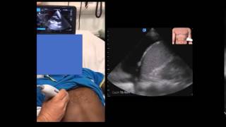 Pleural effusion with mediastinal shift [upl. by Evander]