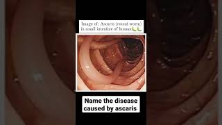 Human Health and Disease  Ascariasis  Round worm [upl. by Ahsinyt]