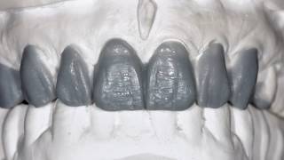 creation CC Feldspathic Veneers dental ceramic Matthias Savvoulidis from wax up to build up [upl. by Franzoni]