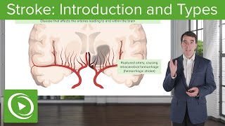 Stroke Introduction and Types  Clinical Neurology [upl. by Htez]