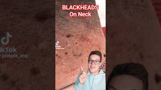 Crazy BLACKHEAD REMOVAL FROM NECK  Perfection shorts [upl. by Edras]