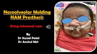 Nasoalveolar Molding NAM prosthesis [upl. by Yrolam]