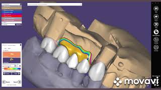 EXOCAD DENTAL TASARIM PROGRAMI İLE MONOLİTİK ZİRKONYUM TASARIMI [upl. by Trinetta]