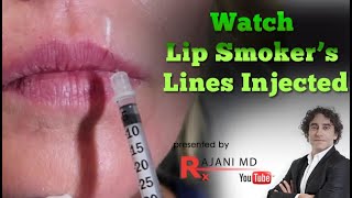 Watch Vertical Lip Smokers Lines Injected with Dermal FillerBefore After Portland [upl. by Cindee]