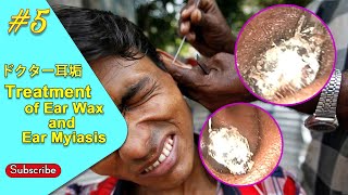 Myiasis of the Ears Ep 5 Ear wax removal 2020 [upl. by Lieno]