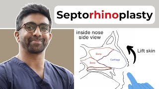 Nasal Surgeon explains Septorhinoplasty [upl. by Edsel]