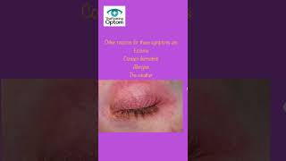 Blepharitis Symptoms Explained 👁️  eyes Rubbing Watering amp More optician [upl. by Dehlia]