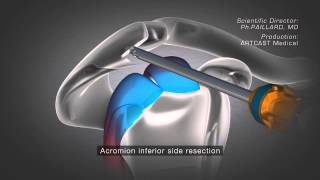 Shoulder Arthroscopy  Acromioplasty [upl. by Einneg33]