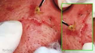 How To Removal Blackheads Big On The Face 194 [upl. by Inoy]