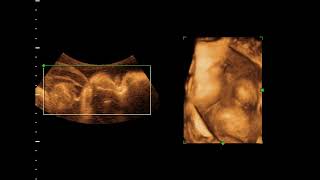 Omphalocele by 4D ultrasound [upl. by Sikorski]