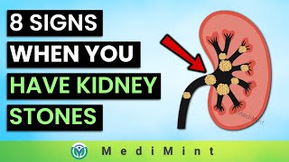 8 Signs and Symptoms When You Have Kidney Stones  MediMint [upl. by Ayaet302]