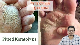 Pitted Keratolysis  Erythrasma  पैर पर होने वाले गड्ढे का इलाज़ fungalinfection fungalinfections [upl. by Venable]