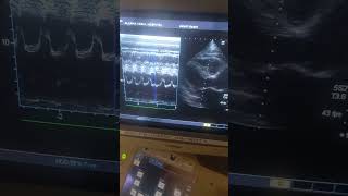 Patient With Severe Mitral regurgitation and atrial fibrillationleft atrium dialted2 [upl. by Sivet]