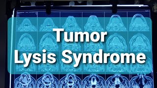 Tumor Lysis Syndrome [upl. by Lilas]