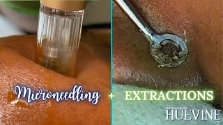 Microneedling  Face Extractions For Ingrown Hairs  HueVine [upl. by Wendi138]