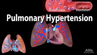 Pulmonary Hypertension Animation [upl. by Leong]