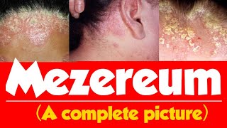 Mezereum homeopathic medicine  Mezereum 30 for psoriasis  Mezereum 200  Mezereum 30 [upl. by Halland]