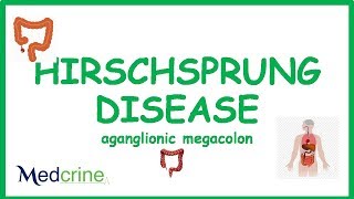 Hirchsprungs Disease Aganglionic Megacolon [upl. by Susumu]