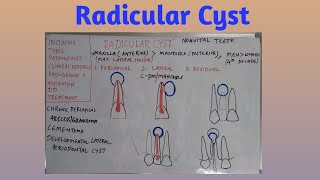 Radicular cyst [upl. by Baldwin]