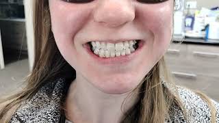 SureSmile Clear Aligners with rubber bands to correct the bite and align the teeth [upl. by Eendys]