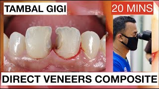 Step by Step Direct Veneers Composite Anterior Multiple Cases 20mins  General Dentist Griya RR [upl. by Wawro399]