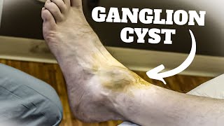 HUGE Ankle Ganglion Cyst Aspiration Surgery  Foot amp Ankle Treatment [upl. by Namas]