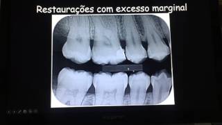 ALTERAÇÕES RADIOGRÁFICAS DAS LESÕES PERIODONTAIS [upl. by Thibaud]