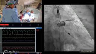 Impella Assisted PCI To A STEMI Patient [upl. by Aicilla]