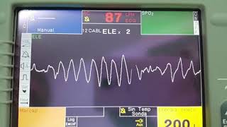 Taquicardia Ventricular Polimorfica 🤯🤯 [upl. by Llenral742]