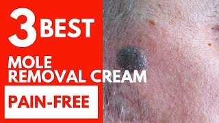 Top 3 Best mole removal creamSurgical Alternative and painfree [upl. by Euginimod]