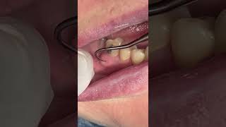 Dental abscess satisfying [upl. by Janie506]