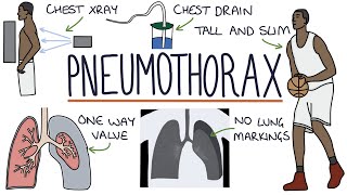 Pneumothorax [upl. by Stepha]