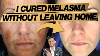 Melasma Treatment At Home Expert Doctors 3 Easy Steps  before and after [upl. by Aleunamme738]