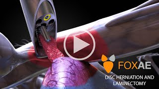 Laminectomy  Legal Animation  Surgery Demonstration [upl. by Ahseniuq474]