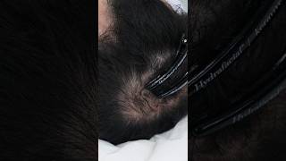 Treating Thinning Hair with Exosome Therapy [upl. by Haerdna]