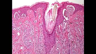 Lecture189 Diagnosing Dermatopathology slides in FCPS exam Part 2 [upl. by Nael]