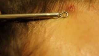 A juicy pimple  hairline zit [upl. by Boj]