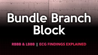 Left and Right Bundle Branch Block ECG Made Easy [upl. by Littlejohn898]