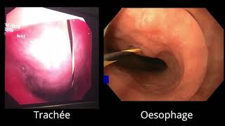 Fermeture d’une fistule œsotrachéale par obturateur type Amplatzer [upl. by Gilberta]