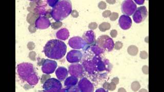 Acute Myelomonocytic Leukemia M4 EO 2 patients [upl. by Evalyn]