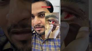 Eye injury  RTA  eye injury by accident eyes eyeinjury accident eyedrop dramansiddiqui [upl. by Adnert]