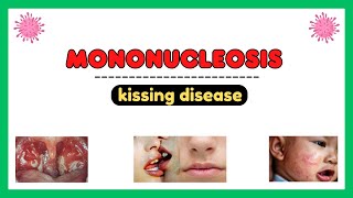 Mononucleosis infection epstein barr virus pathophysiology symptoms diagnosis treatment [upl. by Reseda]