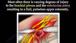 Scapulothoracic Dissociation  Everything You Need To Know  Dr Nabil Ebraheim [upl. by Nine195]