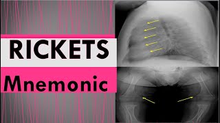 Rickets mnemonics [upl. by Koeppel809]