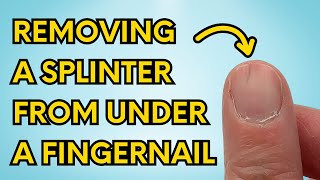 My Simple Trick to Instantly Remove a Splinter From Under Your Fingernail watch until the end [upl. by Goldshell]